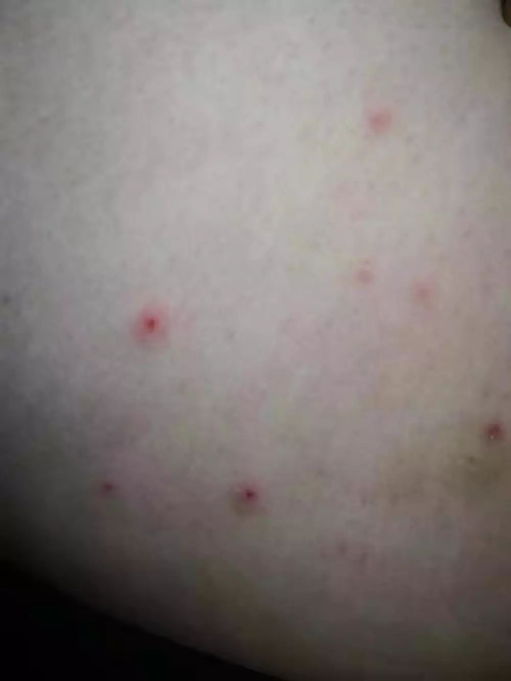 春天会发生虫咬皮炎吗,秋天虫子叮咬