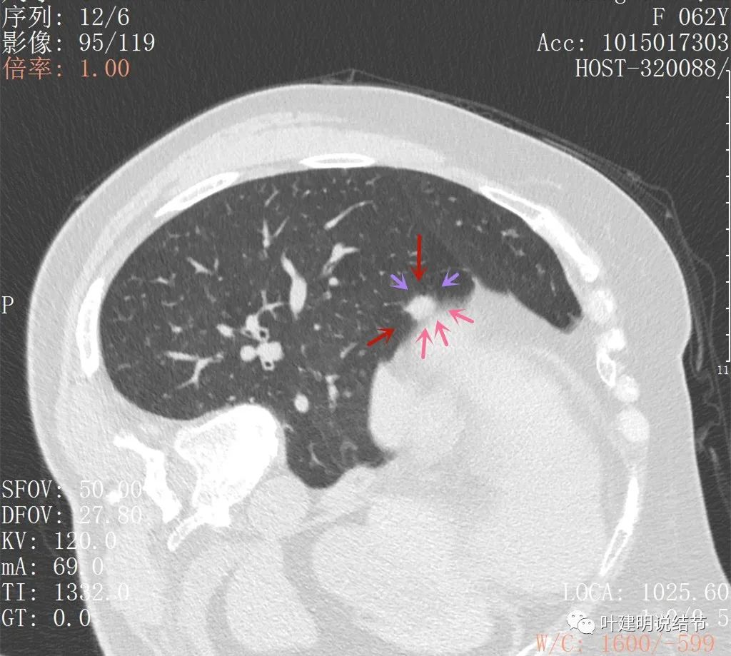左肺癌手术半年右肺下角还有炎症,左下肺癌晚期