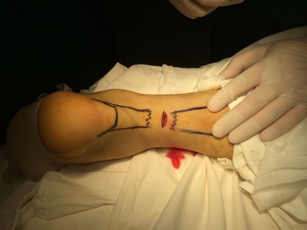 跟腱断裂康复好是什么感觉,跟腱断裂康复后会残疾吗