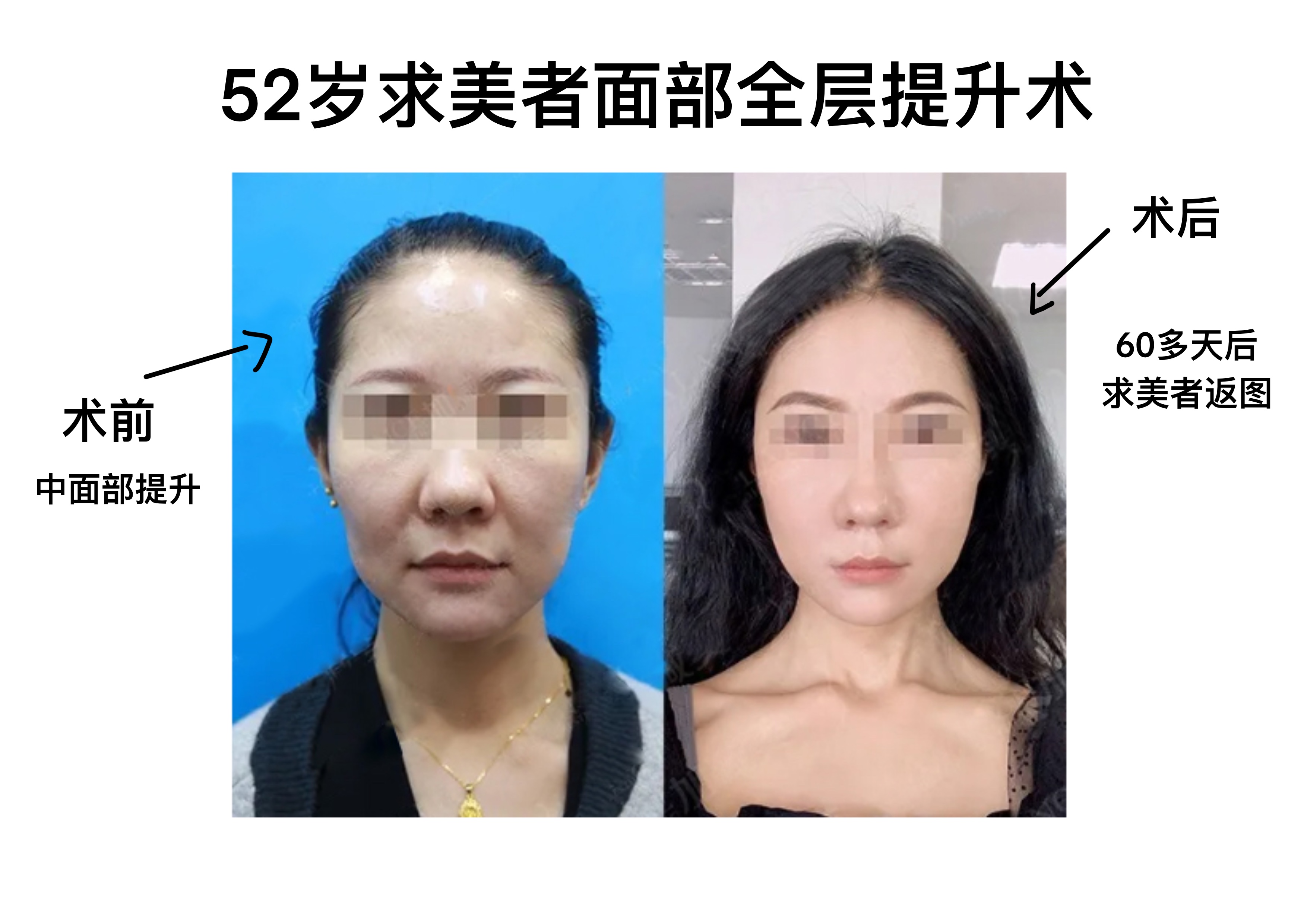 微创拉皮结合线雕,线雕和微创拉皮哪个好