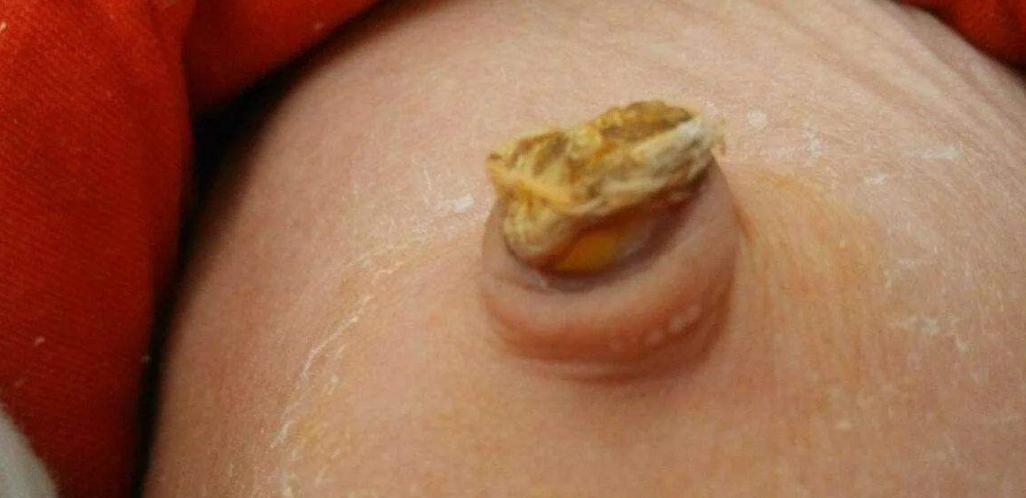 新生儿脐带护理正确的方法,新生儿脐带护理有哪些注意事项