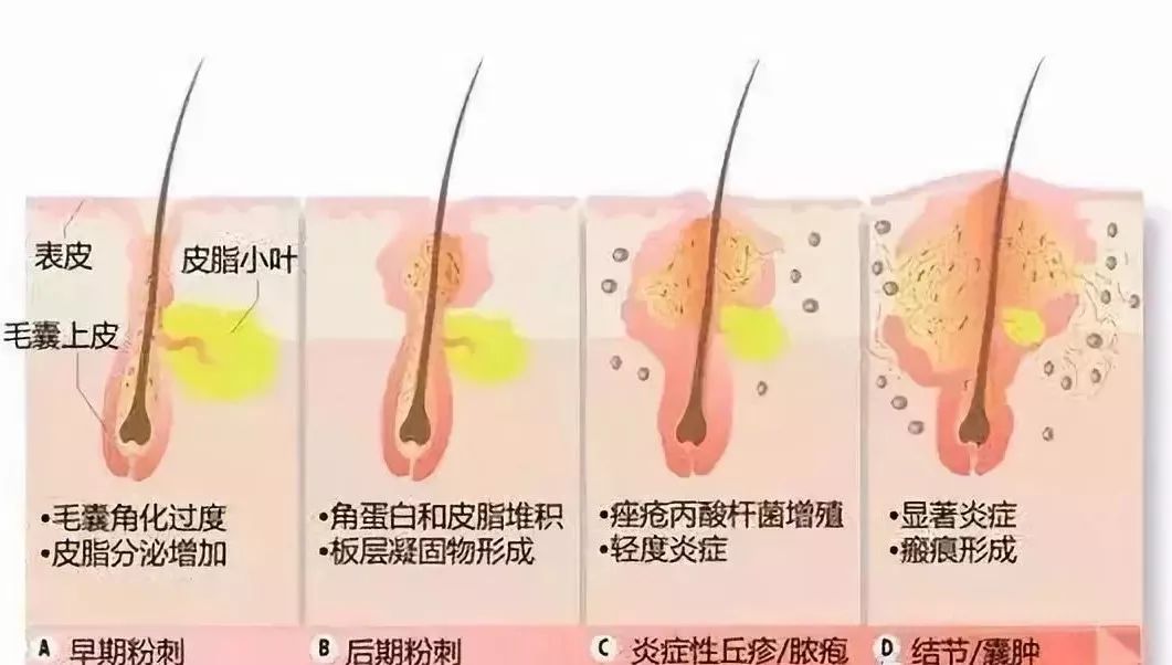 疮是怎么引起的怎么治,长疮的症状和表现有什么