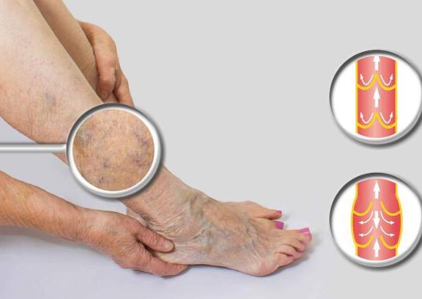 腘静脉血管闭塞腿脚晚上出汗好吗,血管狭窄引起腿脚阵疼吃什么蔬菜