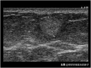 脂肪瘤长得比较快是因为恶变了吗,长了一个脂肪瘤必须赶紧做手术吗