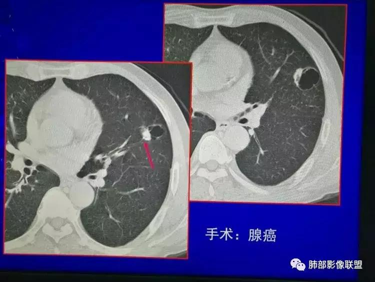 肺癌复查出现多发索条状阴影,肺癌影像学表现
