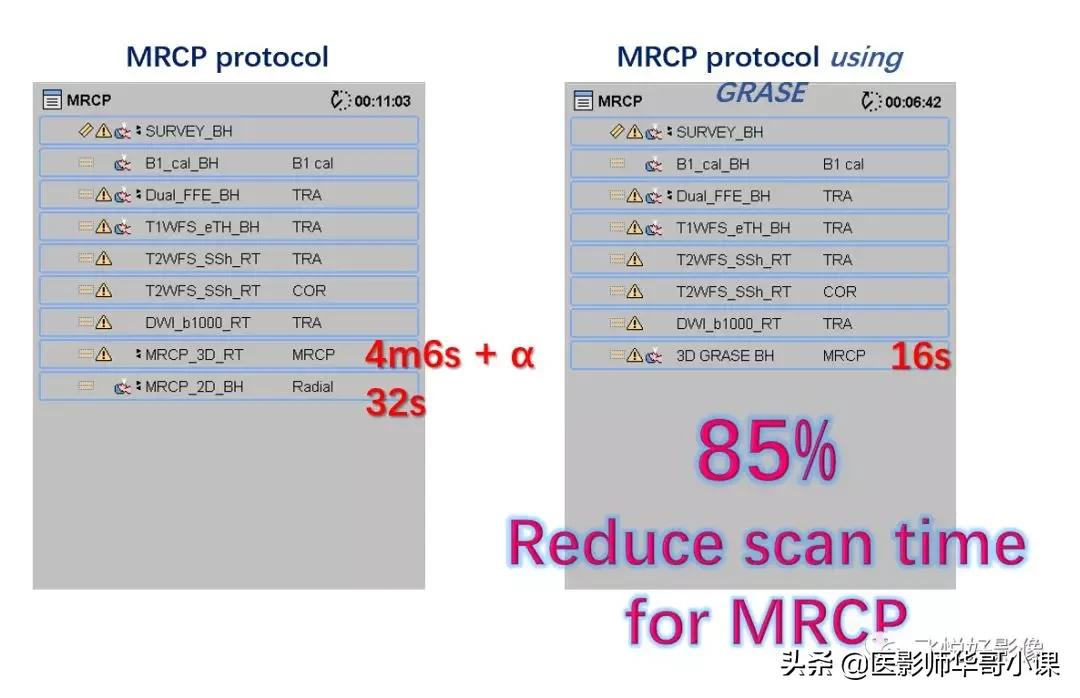 「飞利浦磁共振技术」胆道系统胆胰管水成像之3D_MRCP_BH