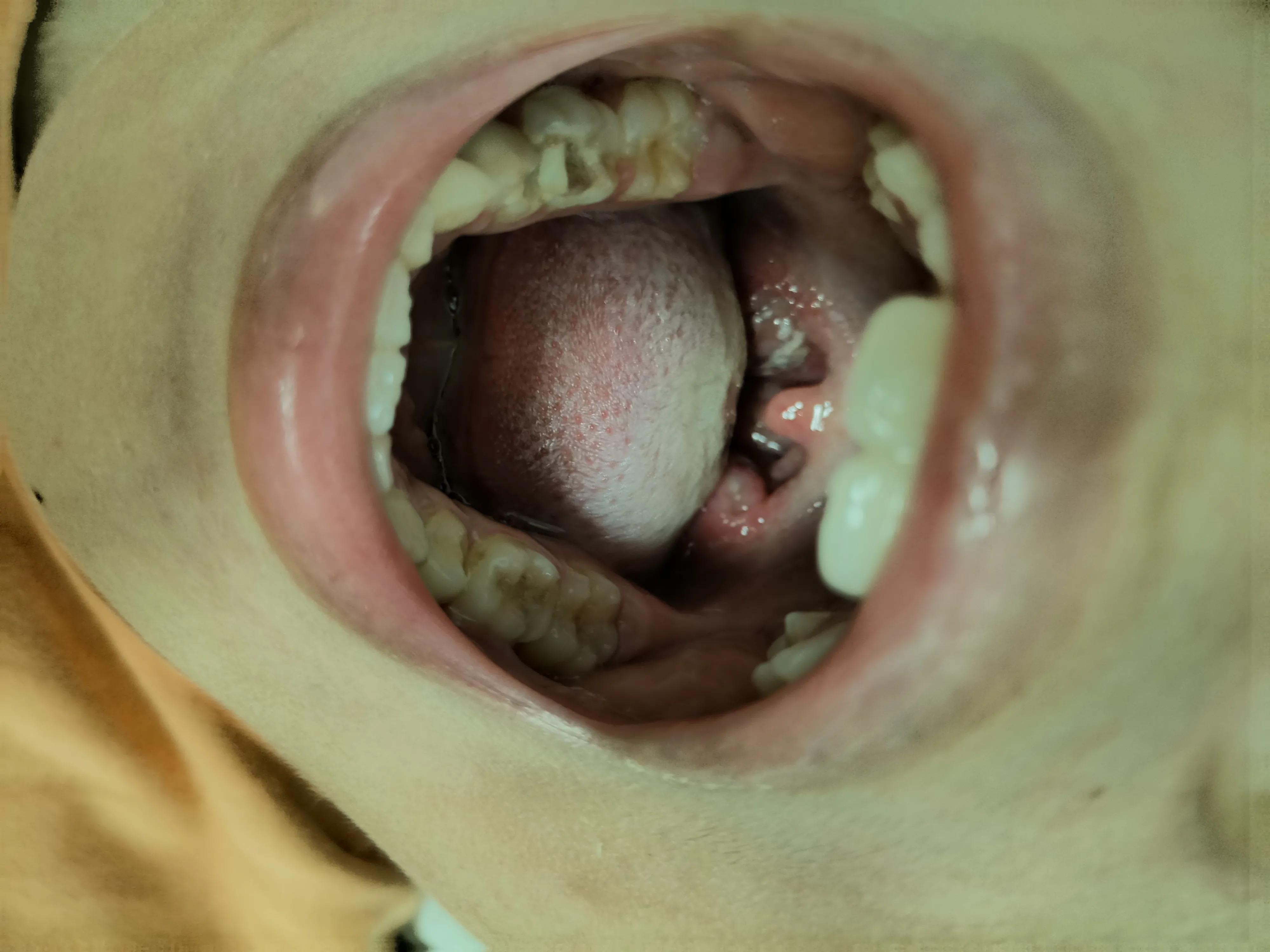 肝功能正常肝质地不均脾肿大,脾肿大肝功能异常血小板减少