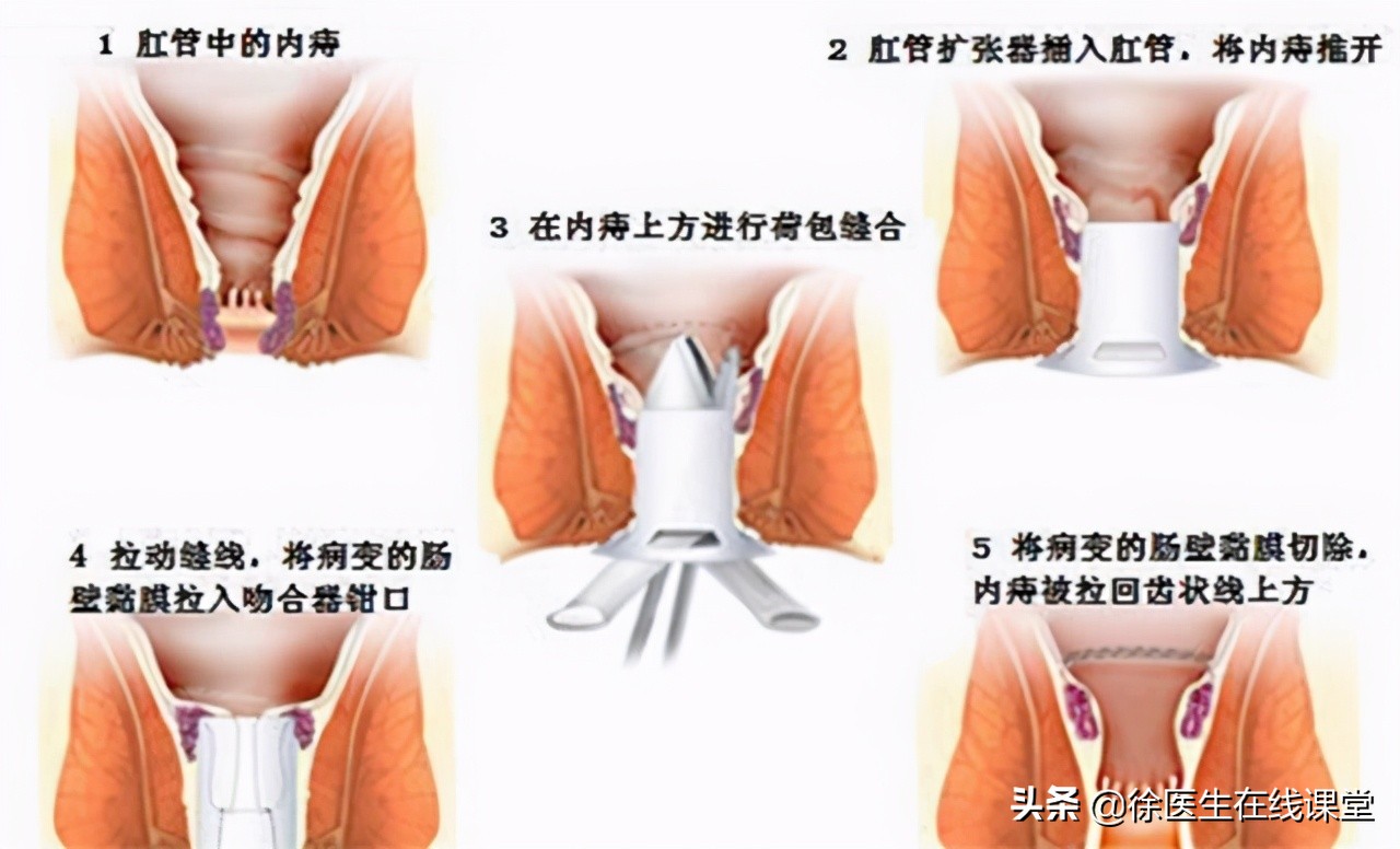 肛门边有个肉球不痛不痒怎么治疗,肛门外有个肉球不痛不痒怎么治疗