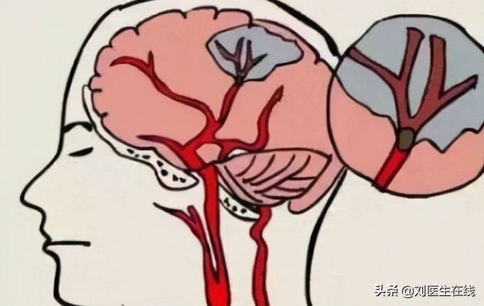 55岁王阿姨长期吃阿司匹林，却脑梗复发，医生心脏听诊找到了原因