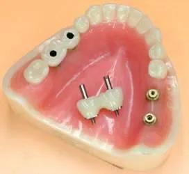 种植牙的牙冠掉下来的原因,种植牙牙冠脱落是医疗事故吗