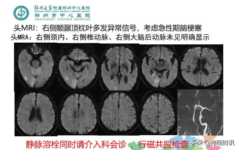 静脉溶栓怎么引起的,静脉相关并发症的预防及处理