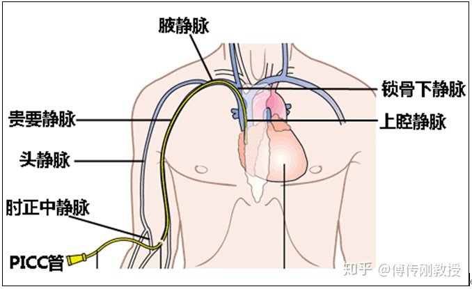 三期直肠癌生存率,直肠癌的4个阶段