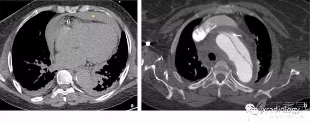 急性主动脉综合征报道,急性主动脉综合征症状