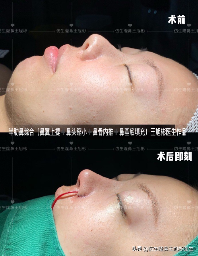 耳软骨隆鼻鼻小柱也是用耳软骨吗,耳软骨隆鼻可以摸到鼻尖的软骨吗