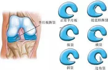 半月板磨损,解密髋关节