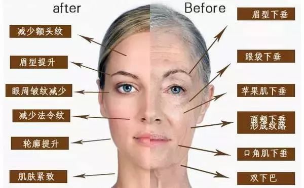 超声刀能抚平皱纹吗,超声刀让人更快衰老吗