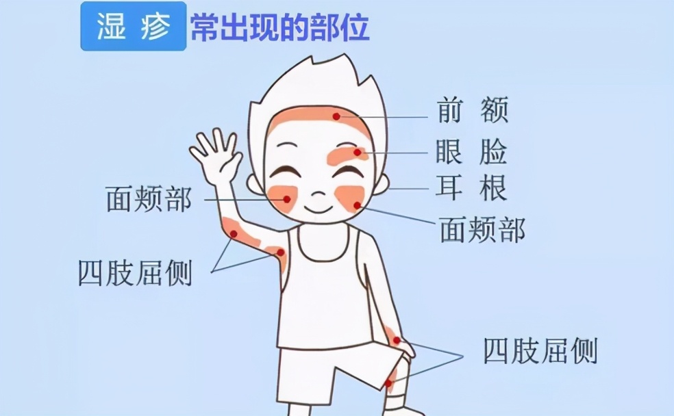 宝宝湿疹严重反反复复怎么办,宝宝湿疹反反复复怎么处理啊