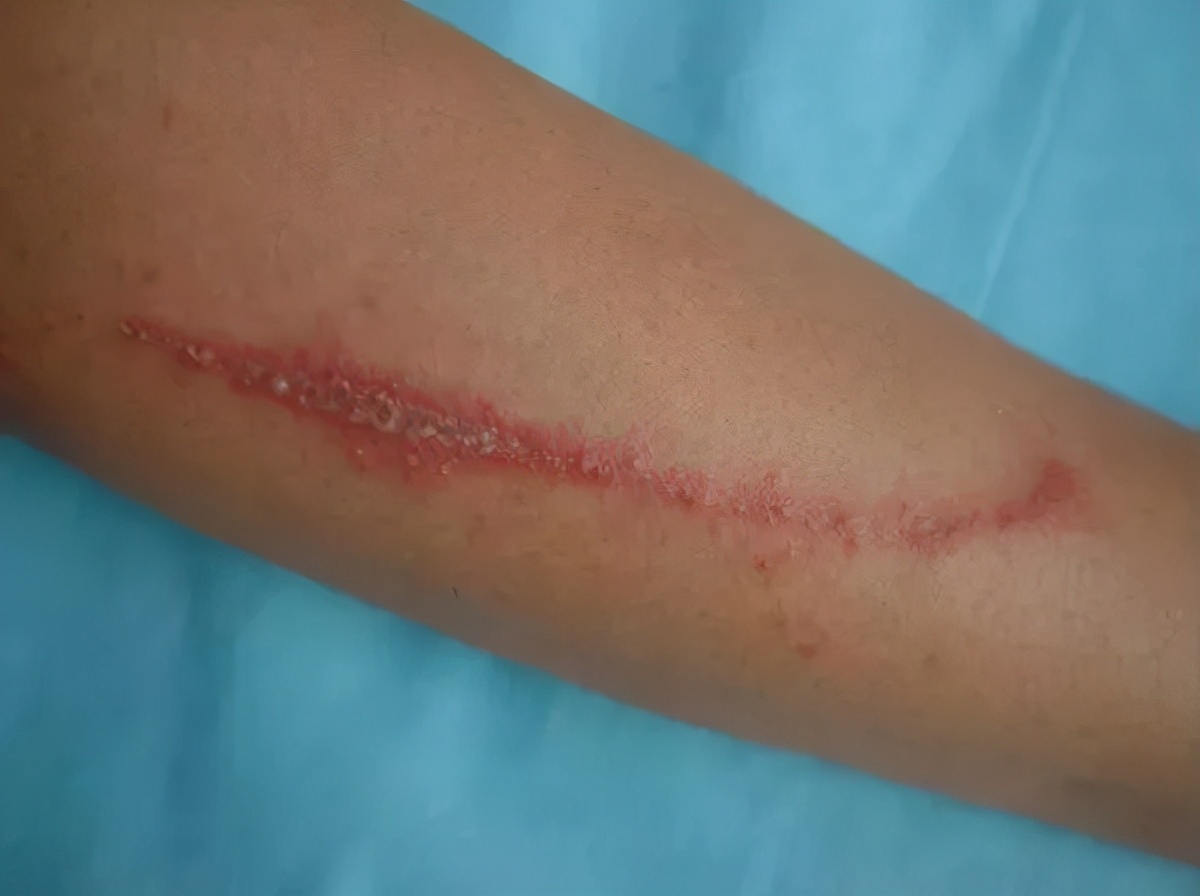 小女孩被虫子咬了差点毁容,虫子咬小孩差点毁容