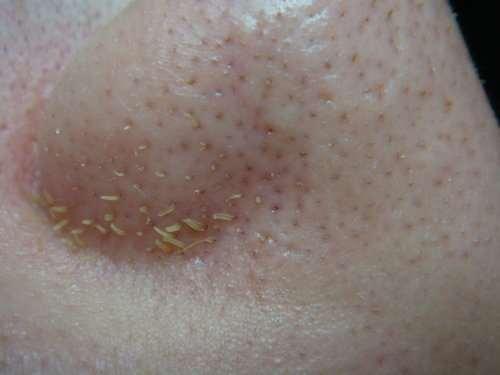 鼻头螨虫有什么药可以根治,鼻头上有螨虫用什么药