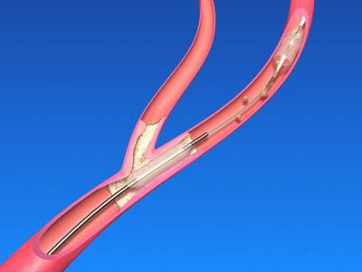 介入治疗血栓,脑静脉窦血栓还可以介入治疗吗