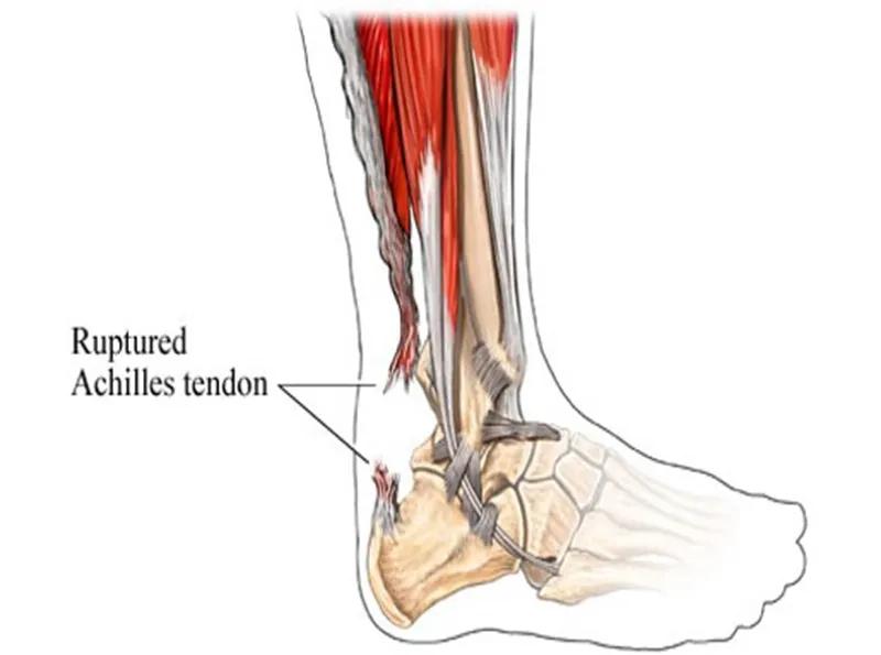 跟腱断裂术后康复训练,跟腱断裂恢复的小偏方