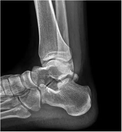 踝关节撞击症问诊,踝关节内侧撞击综合症位置图