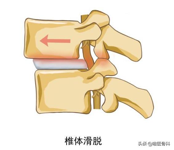 腰椎间盘突出医生建议手术怎么办,腰椎间盘突出打钉子和做镜子