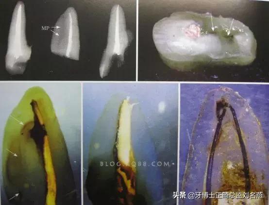 根管治疗难点与解决方案,根管治疗牢固吗