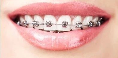 戴牙套第二天牙酸软疼怎么缓解,戴上牙套后中间缝有口水