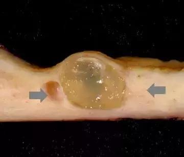 宫颈糜烂肥大囊肿会引起宫颈癌吗,宫颈肥大宫颈糜烂宫颈囊肿症状