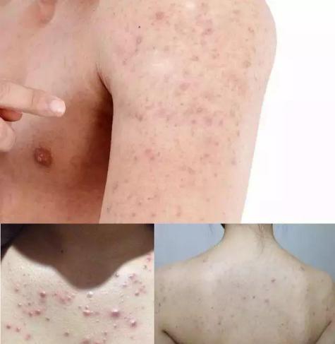 日本去螨虫皂,日本小黑皂号称螨虫克星