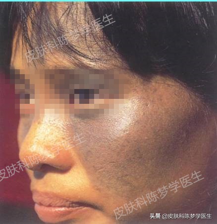 褐青斑是雀斑样痣吗,脸上太田痣怎么祛斑
