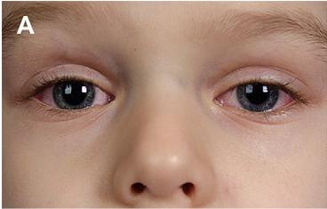 川崎病一定会引起冠状动脉扩张吗,川崎病冠状动脉扩大对娃的影响