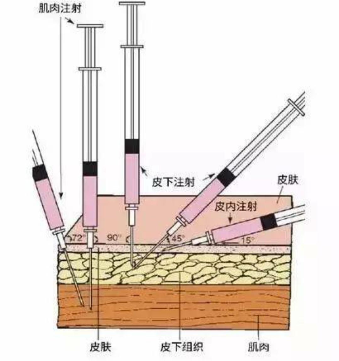 鐙楃嫍鐤嫍姝ｇ‘娉ㄥ皠鏂规硶,鐙楃嫍娉ㄥ皠鐤嫍瑙嗛鏁欑▼