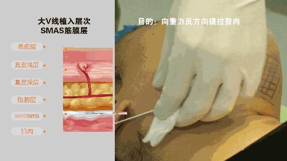 抗衰线雕面部提升多久做一次,无针线雕局部抗衰