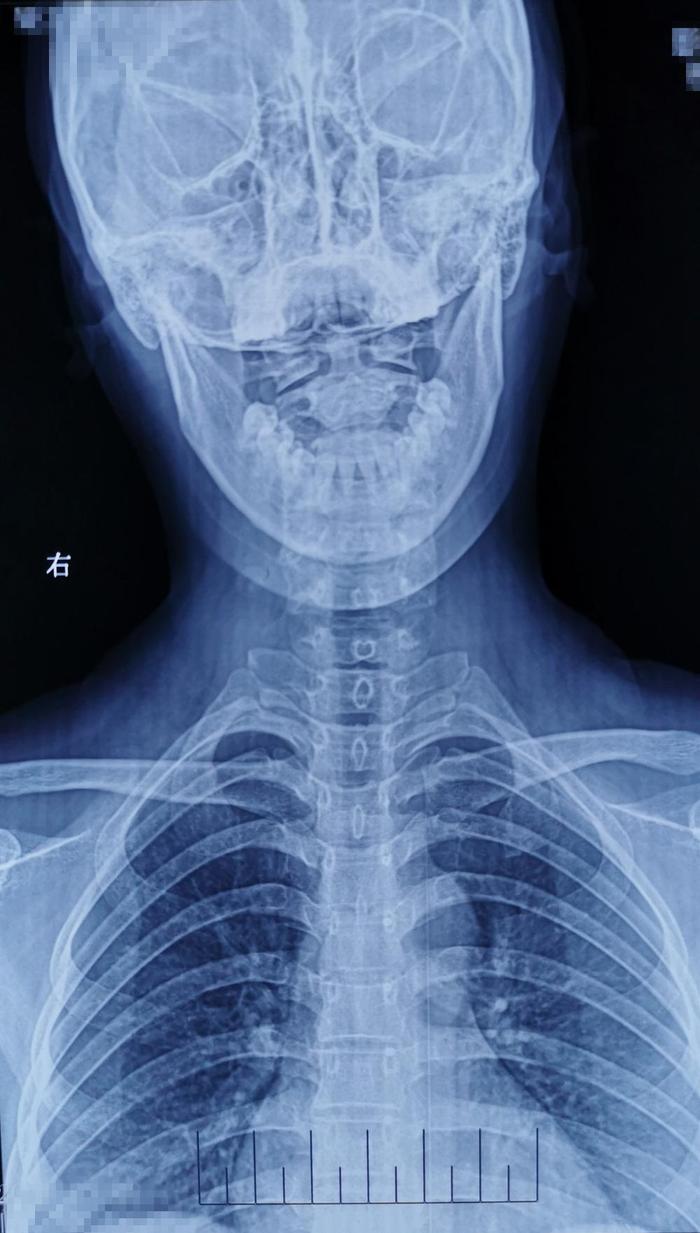 因颈背部疼痛、上臂抽疼，检查出颈5椎体结核