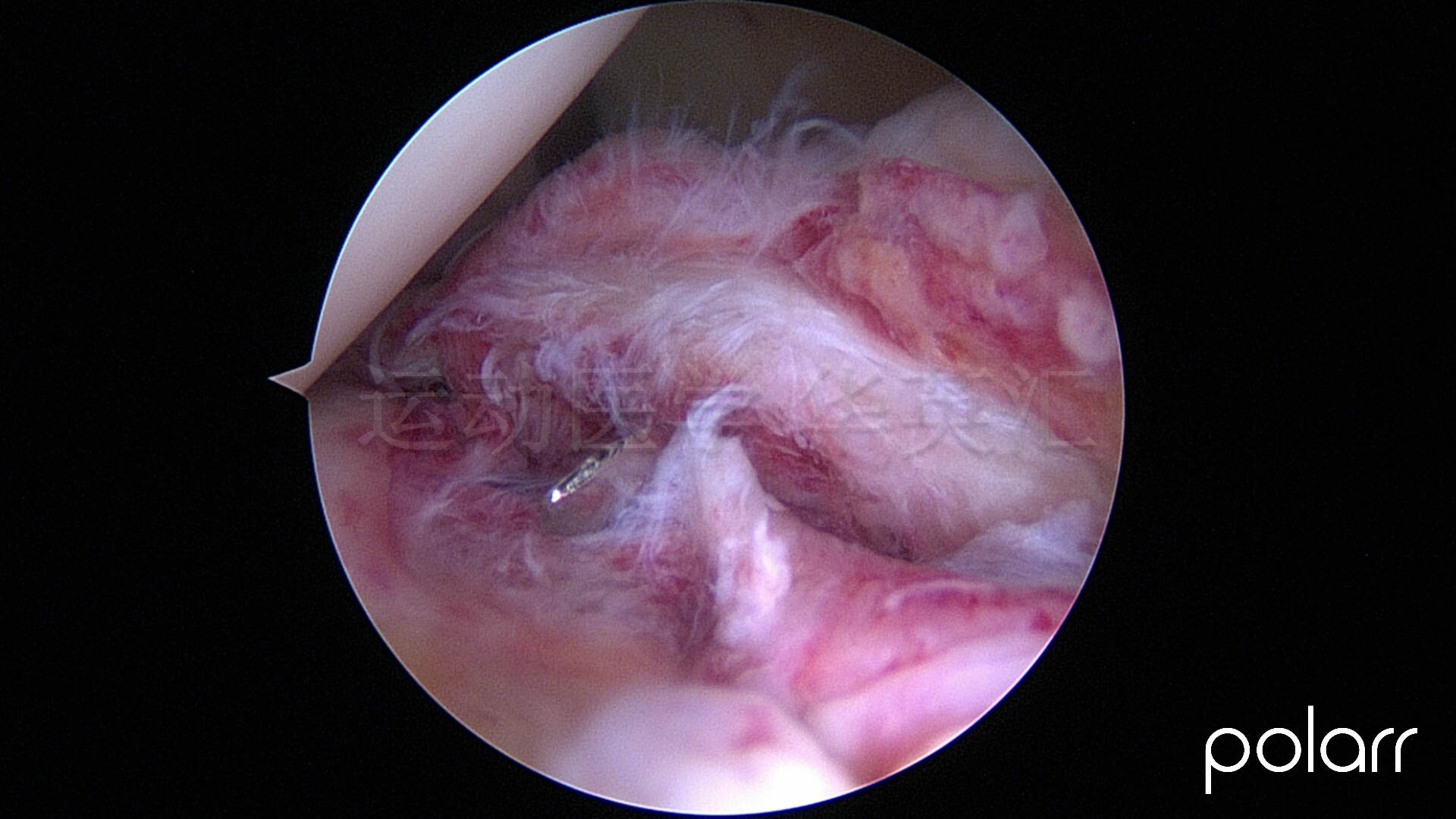 前交叉韧带断裂十年还需要治吗,前交叉韧带1°损伤能自愈吗