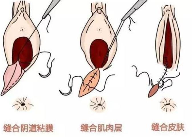 顺产侧切会有什么影响,顺产时侧切对今后生活有啥影响