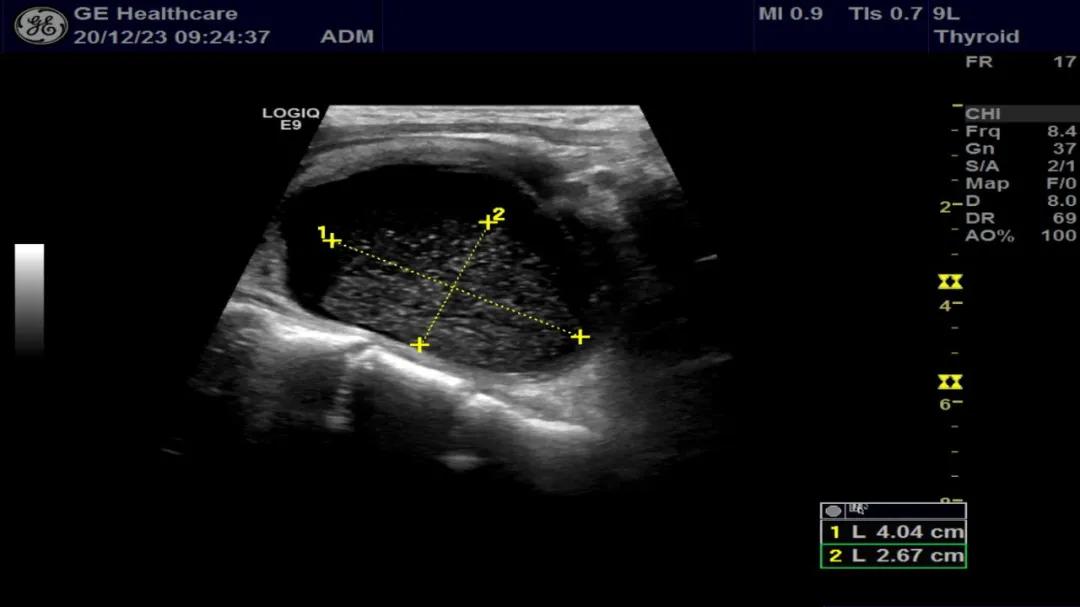 甲状腺囊肿介入,甲状腺囊肿介入治疗效果如何