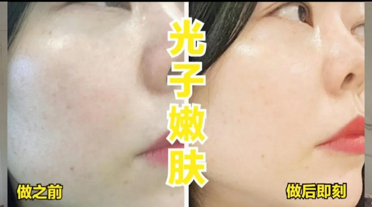 医疗美容去斑做什么项目最好,过年必做的4个医美项目