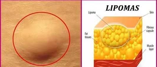 皮肤长肉疙瘩、脂肪瘤？4味中药，一消一补，标本兼顾