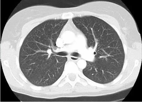 检查手段五花八门该如何抉择?医生教你选择肺癌诊断的最佳手段