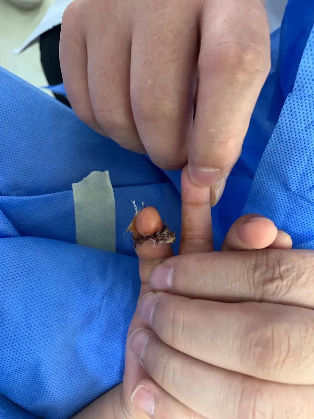 断指再植接动脉显微镜视频,穿针引线手术