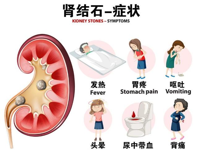 双肾结石手术后五月后又有新结石,女子右肾取出一盘结石
