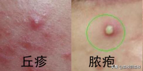 为什么痘痘总是长在同一位置上,同一个位置反复长痘痘怎么治