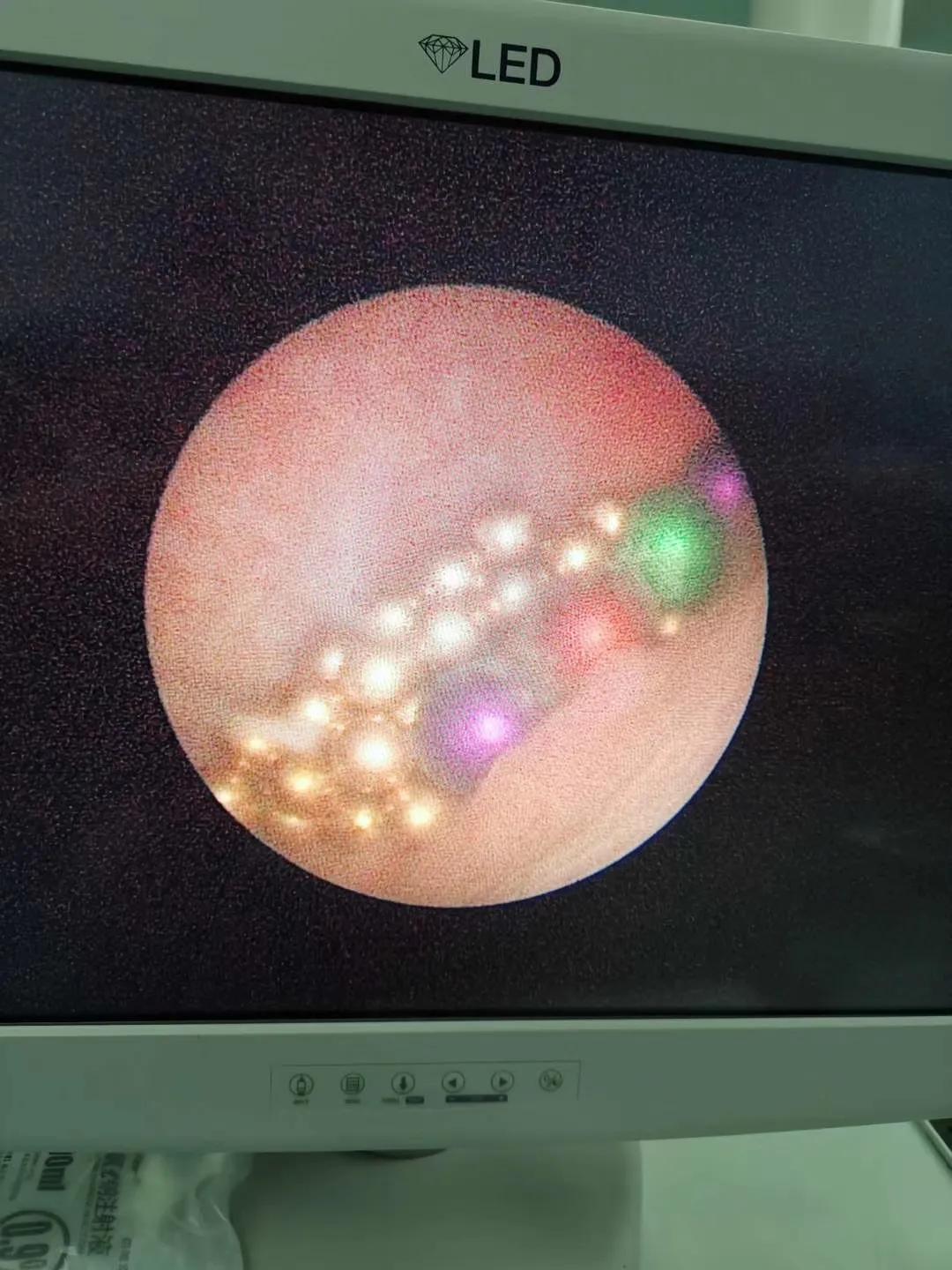 四岁小男孩往小丁丁里塞弹珠?那些年孩子塞进去的东西远不止这个