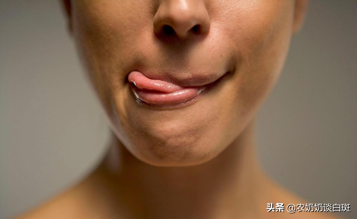 舔一舔：女子变烈焰红唇？白癜风在嘴巴上来回跳跃