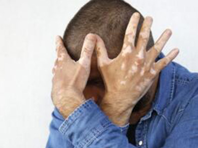 白癜风照完光发红发痒好还是不好,白癜风抹了卡力孜然酊发痒怎么治