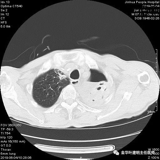 手术引起乳糜胸,有没有做了肺结节手术后是误诊的