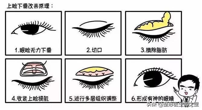 大小眼双眼皮能做眼综合手术吗,眼综合双眼皮全切